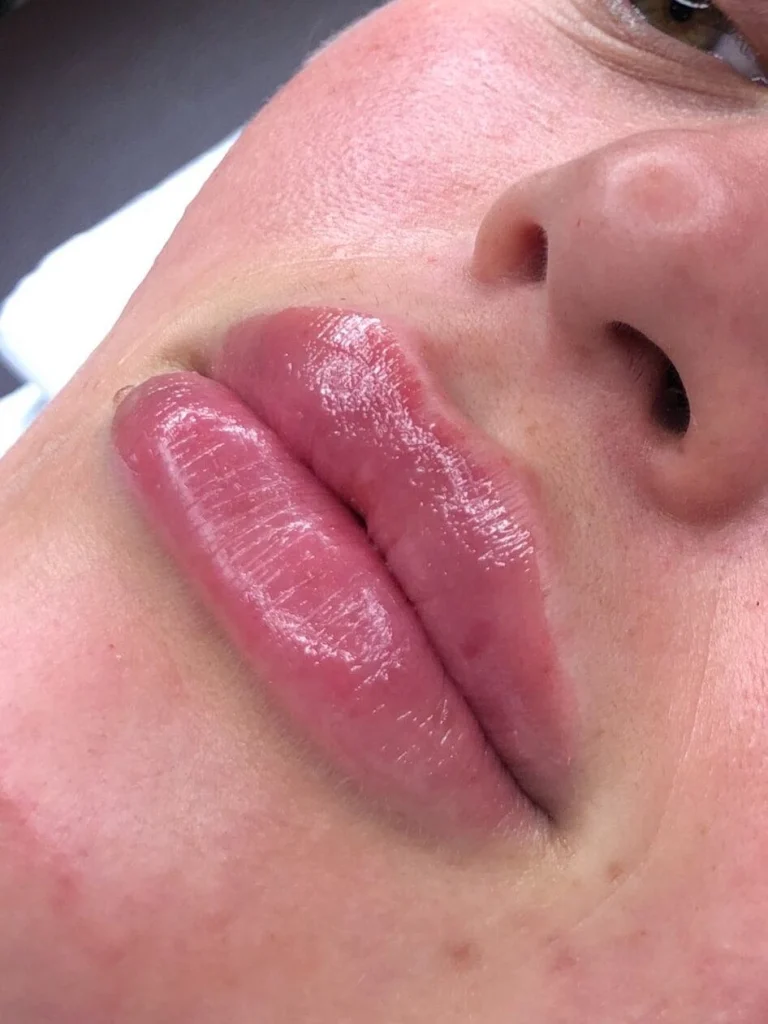 Lip Fillers 01 edited