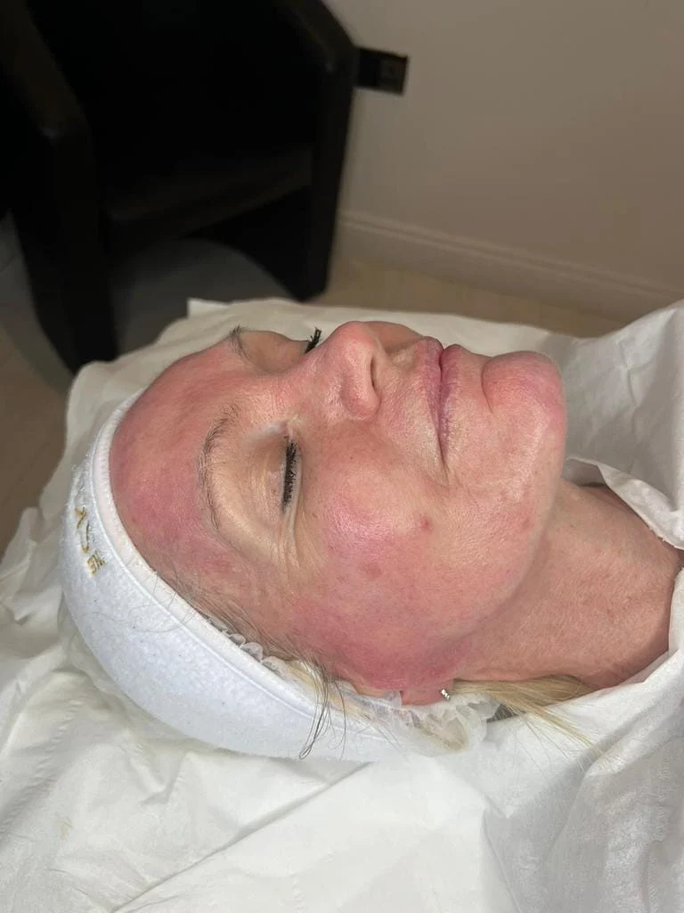 Microneedling 02