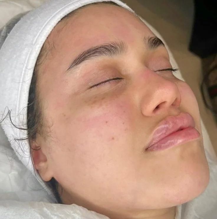 Microneedling 03