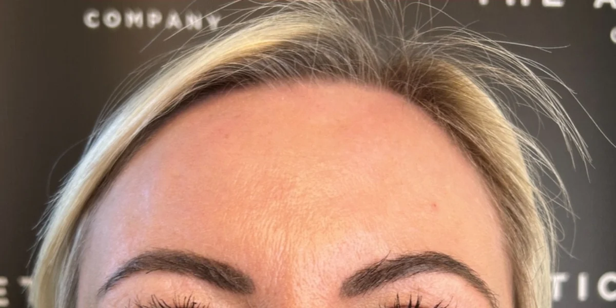 Anti-wrinkle injections, after