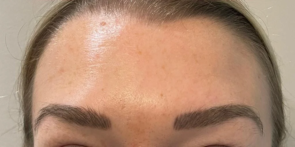Anti-wrinkle injections, after