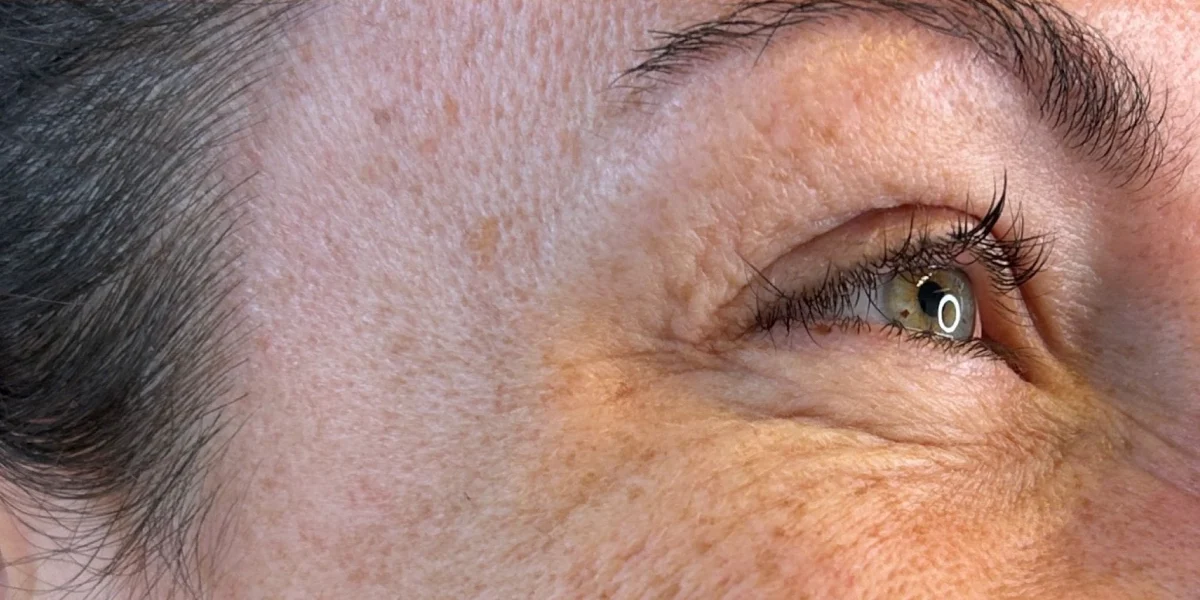 Anti-wrinkle injections, after