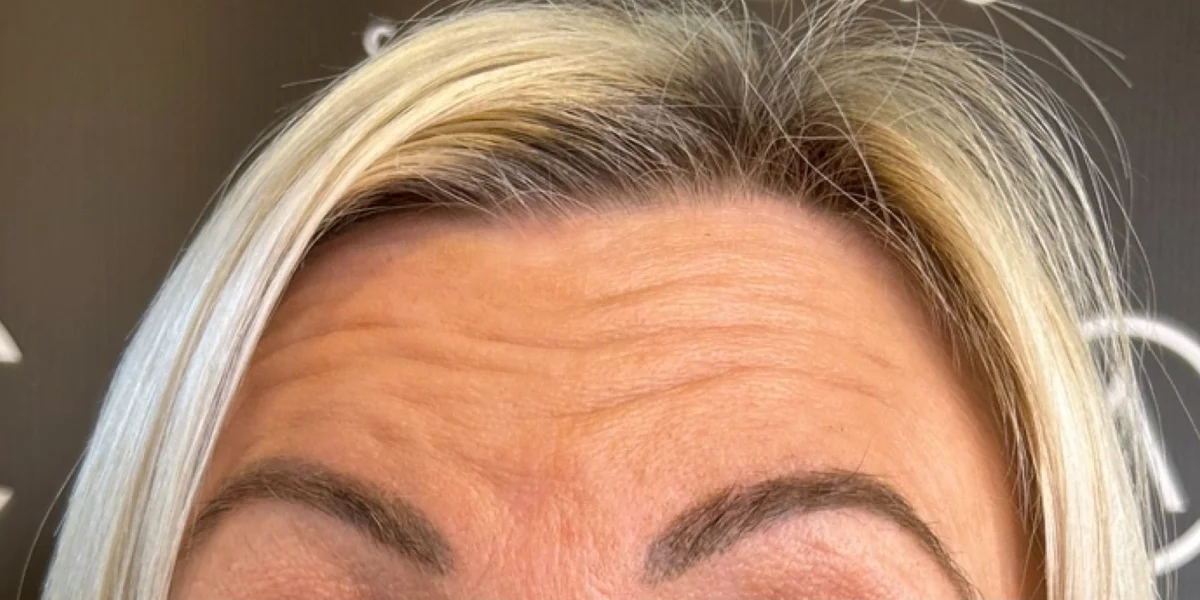 Anti-wrinkle injections, before