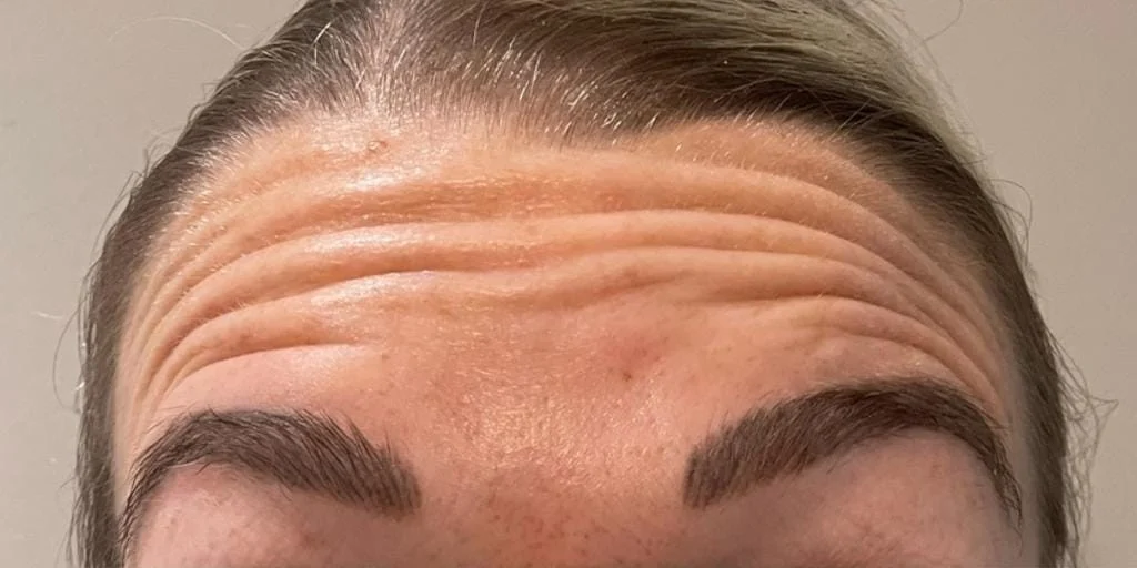 Anti-wrinkle injections, before