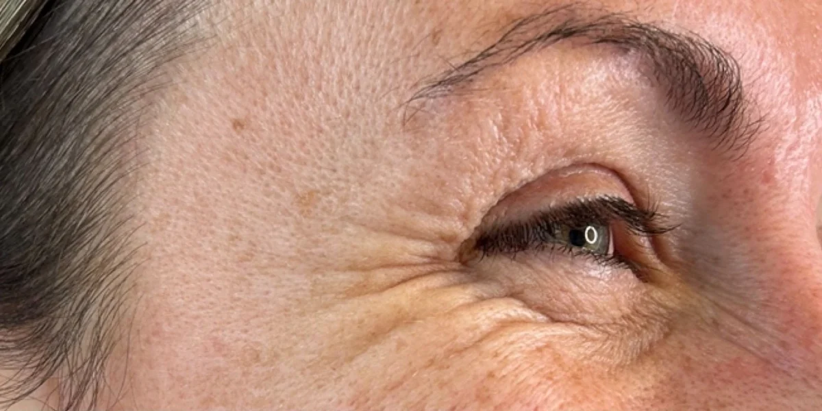 Anti-wrinkle injections, before